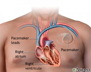 pacemaker_nlm_nih_gov